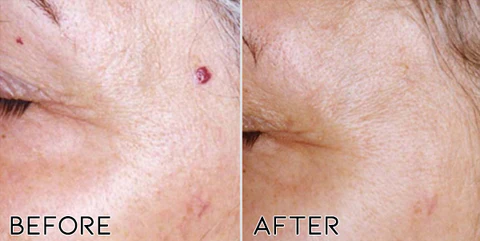 Clearasil™ Petechiae Removal Cream - Image 2