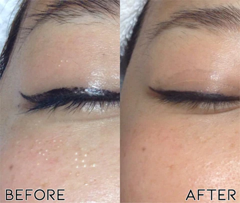 DermaPRO Speedy Milia Remover - Image 2