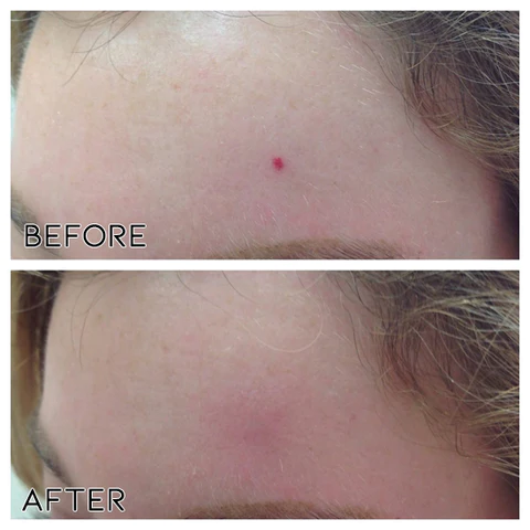 Clearasil™ Petechiae Removal Cream - Image 3