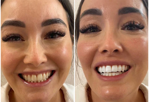 CLAIRE™ France Professional Teeth Whitening Essence - Image 2