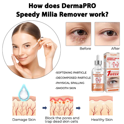 DermaPRO Speedy Milia Remover - Image 5