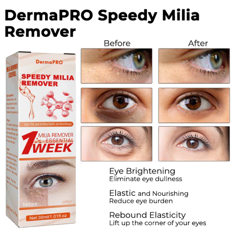 DermaPRO Speedy Milia Remover - Image 8