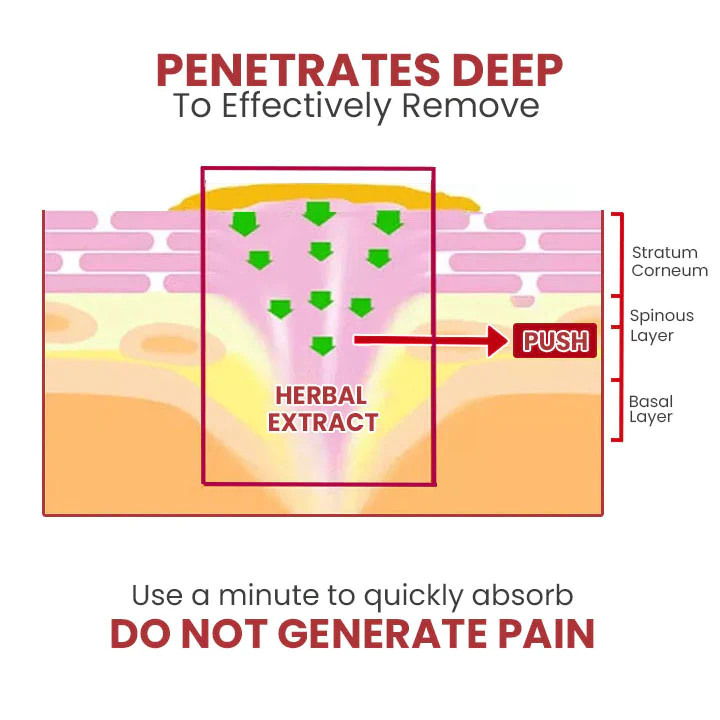 HOLO Medical Wart Removal Cream - Image 2