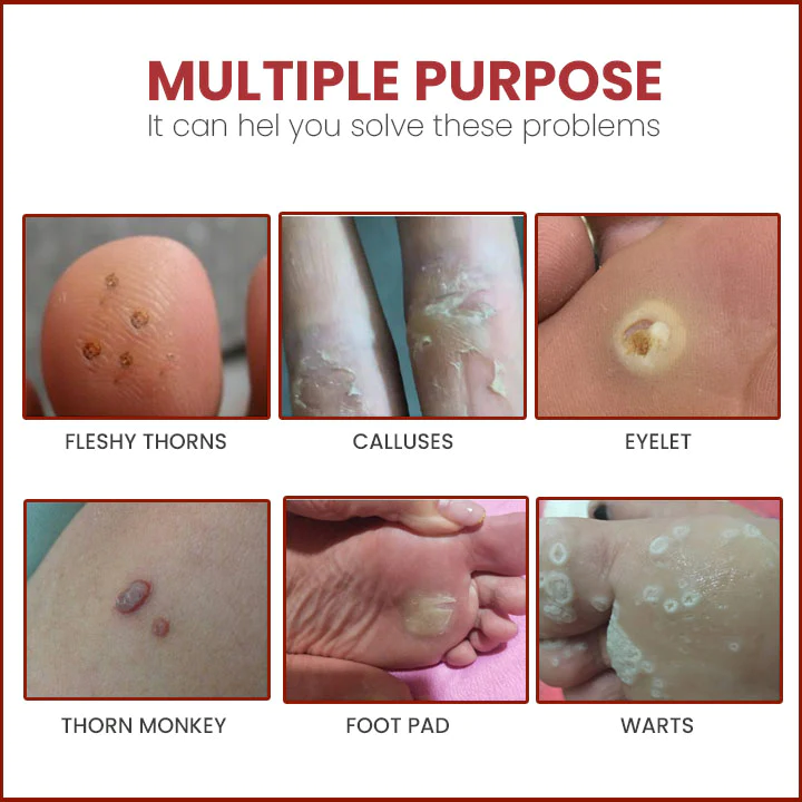 HOLO Medical Wart Removal Cream - Image 5