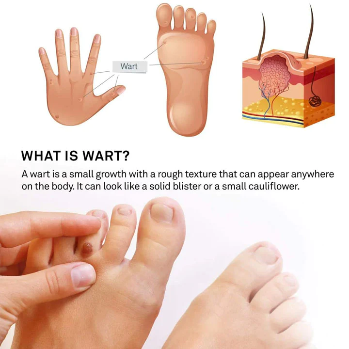 HOLO Medical Wart Removal Cream - Image 8