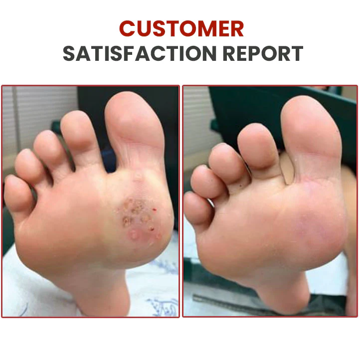 HOLO Medical Wart Removal Cream - Image 10