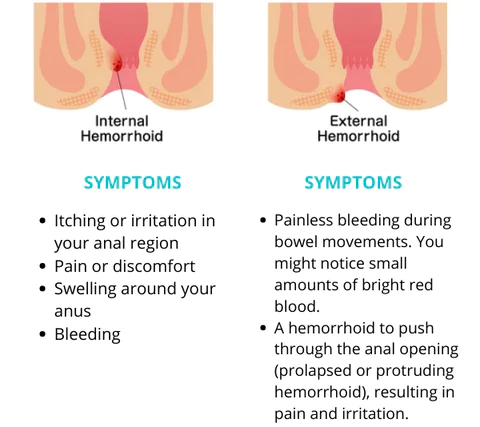HealmuszPRO Natural Herbal Hemorrhoids Ointment - Image 7