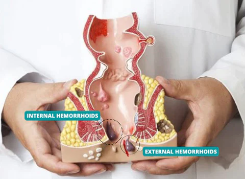 HealmuszPRO Natural Herbal Hemorrhoids Ointment - Image 6