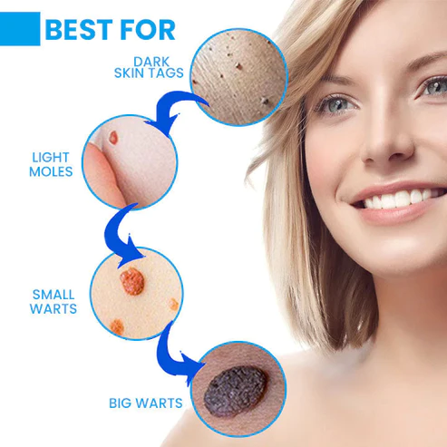 Instant Wart Removal Ointment - Image 3