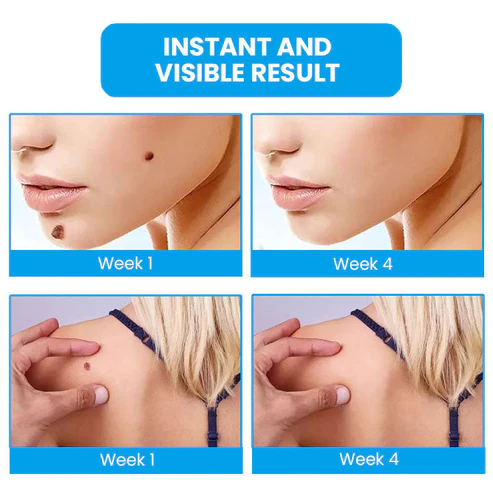 Instant Wart Removal Ointment - Image 9