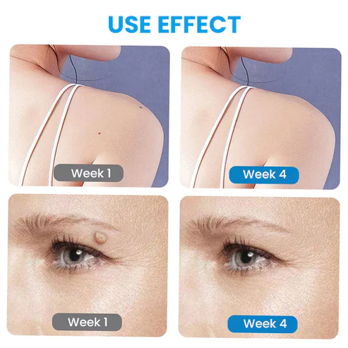 Instant Wart Removal Ointment - Image 8