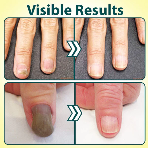 NailRestore Anti-Fungal Treatment Essence - Image 7