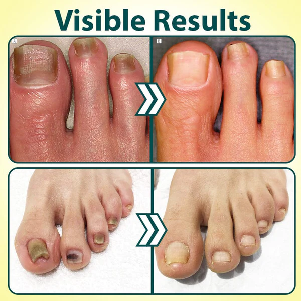 NailRestore Anti-Fungal Treatment Essence - Image 8