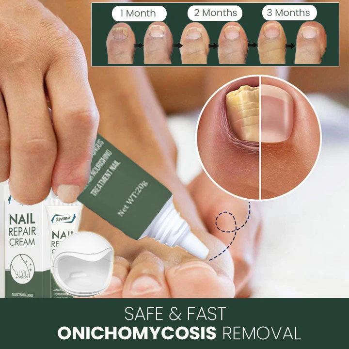 LifeMed Home Use Onychomycosis Fungal Laser Treatment - Image 5