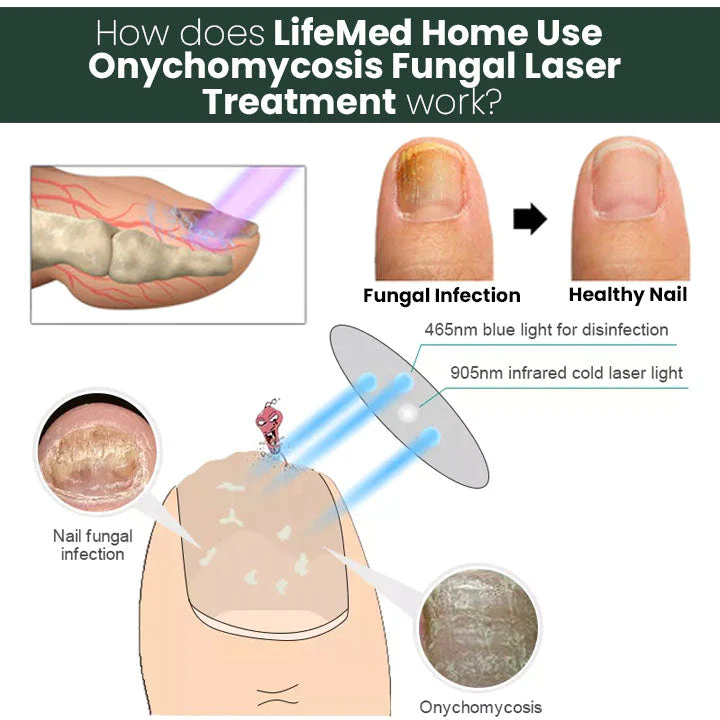 LifeMed Home Use Onychomycosis Fungal Laser Treatment - Image 4