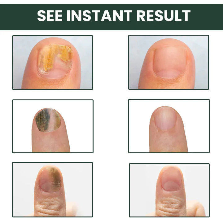LifeMed Home Use Onychomycosis Fungal Laser Treatment - Image 8