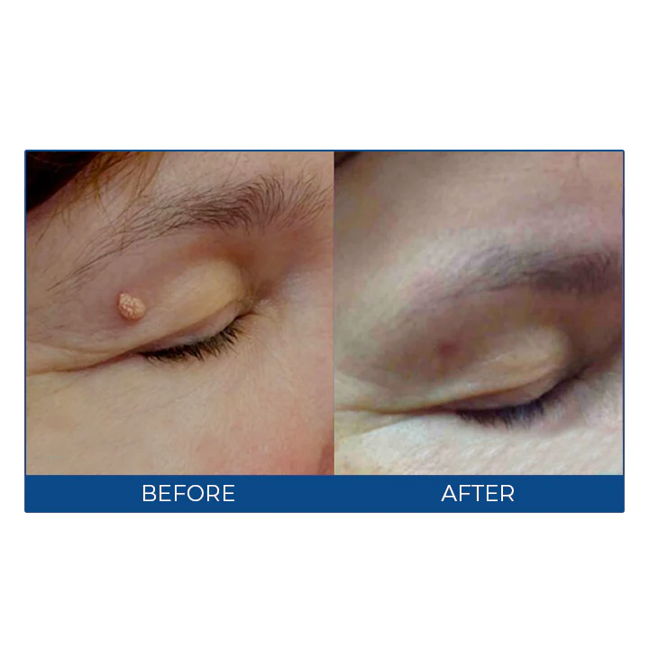 MEDix™ Wart-Off Cream - Image 8