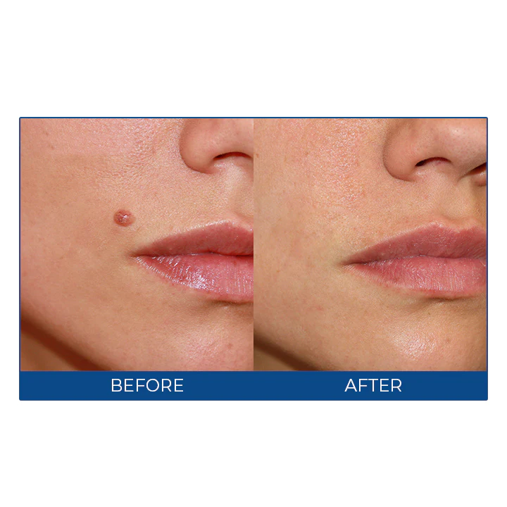 MEDix™ Wart-Off Cream - Image 9