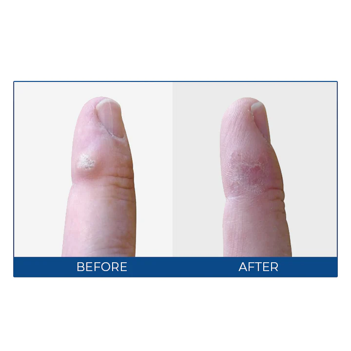 MEDix™ Wart-Off Cream - Image 10