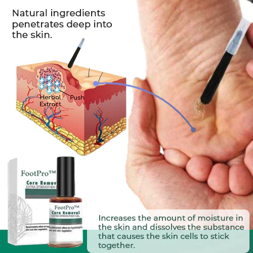 FootPro™ Corn Removal Extra Strengthen Gel(Limited time discount 🔥 last day) - Image 4