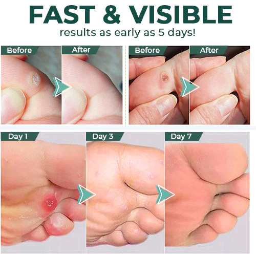 FootPro™ Corn Removal Extra Strengthen Gel(Limited time discount 🔥 last day) - Image 3