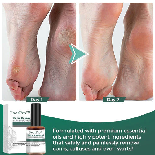 FootPro™ Corn Removal Extra Strengthen Gel(Limited time discount 🔥 last day) - Image 5