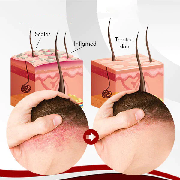 Dermax™ Psoriasis Soap - Image 4