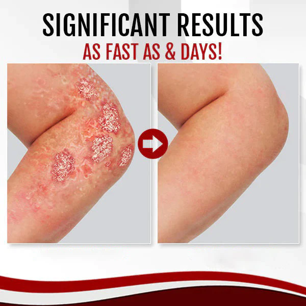 Dermax™ Psoriasis Soap - Image 3