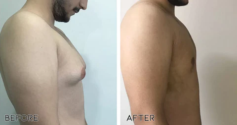 ChestIgnitePLUS Gynecomastia Targeted Heating Balm - Image 3