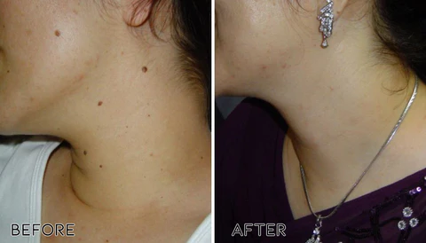 ClearAway PRO Wart Removal Rose Oil Soap - Image 2