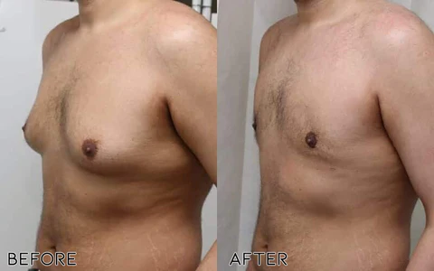 ChestIgnitePLUS Gynecomastia Targeted Heating Balm - Image 2