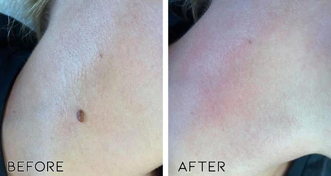 ClearAway PRO Wart Removal Rose Oil Soap - Image 3