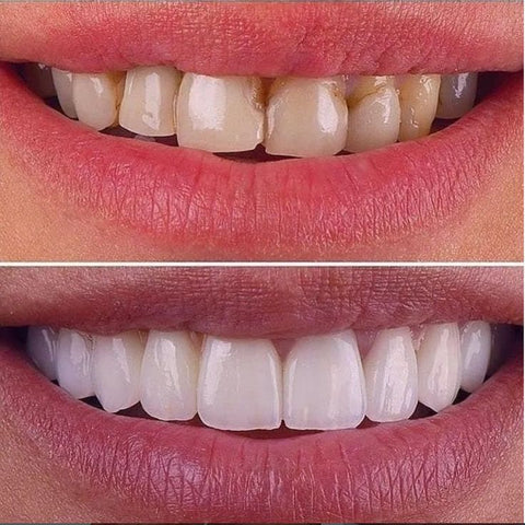 Coconut Oil Teeth Whitening Strips - Image 9