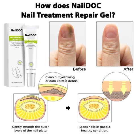 NARC™ Removal Paronychia Gel - Image 2