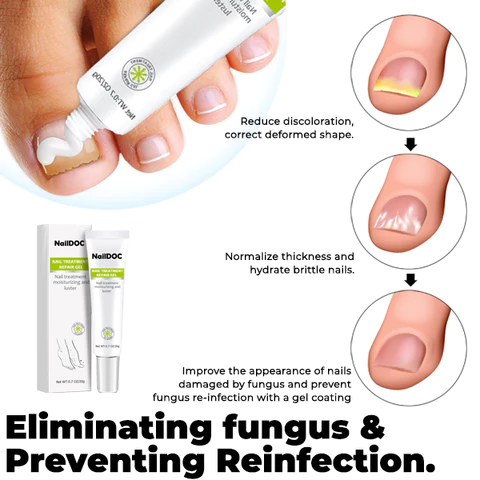 NARC™ Removal Paronychia Gel - Image 3