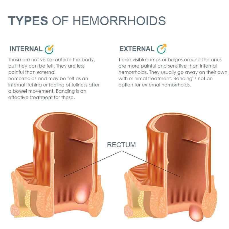 HemorrHeal Herbal RapidRelief Ointment - Image 8