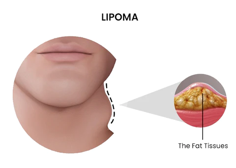 LipomaCure SCI Soothing Ointment - Image 4