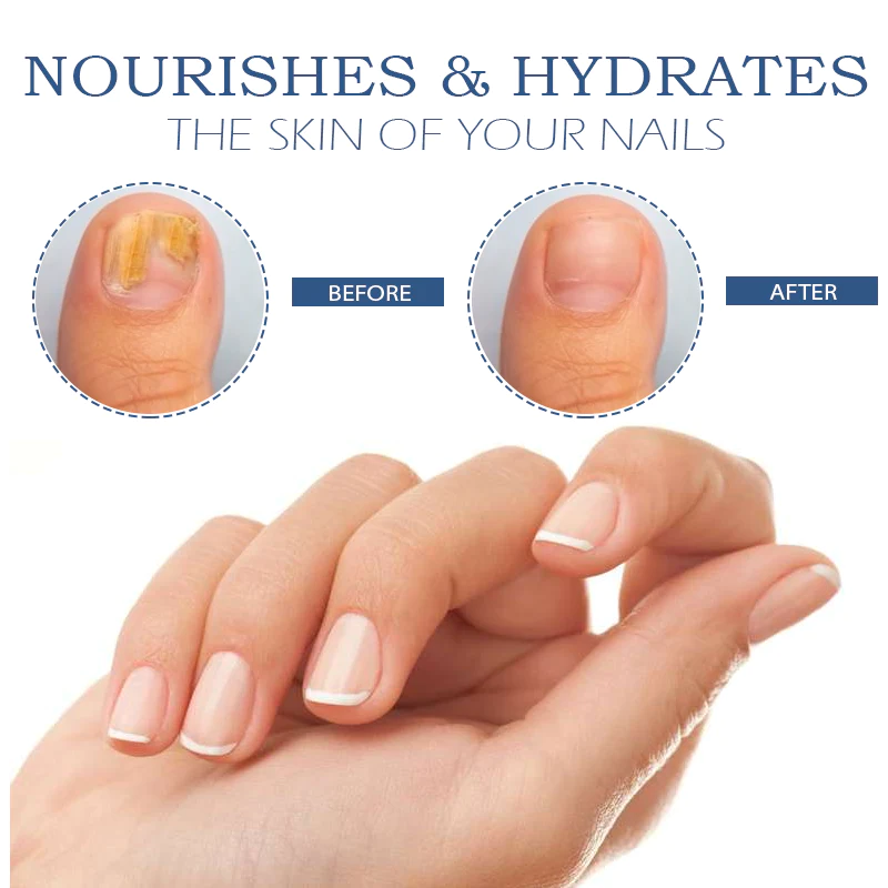 NailRenewal FungusTreatment Pen - Image 6