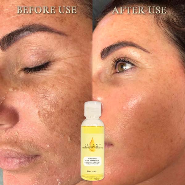 Oilex™ Natural Spots Whitening Yellow Peeling Oil - Image 3