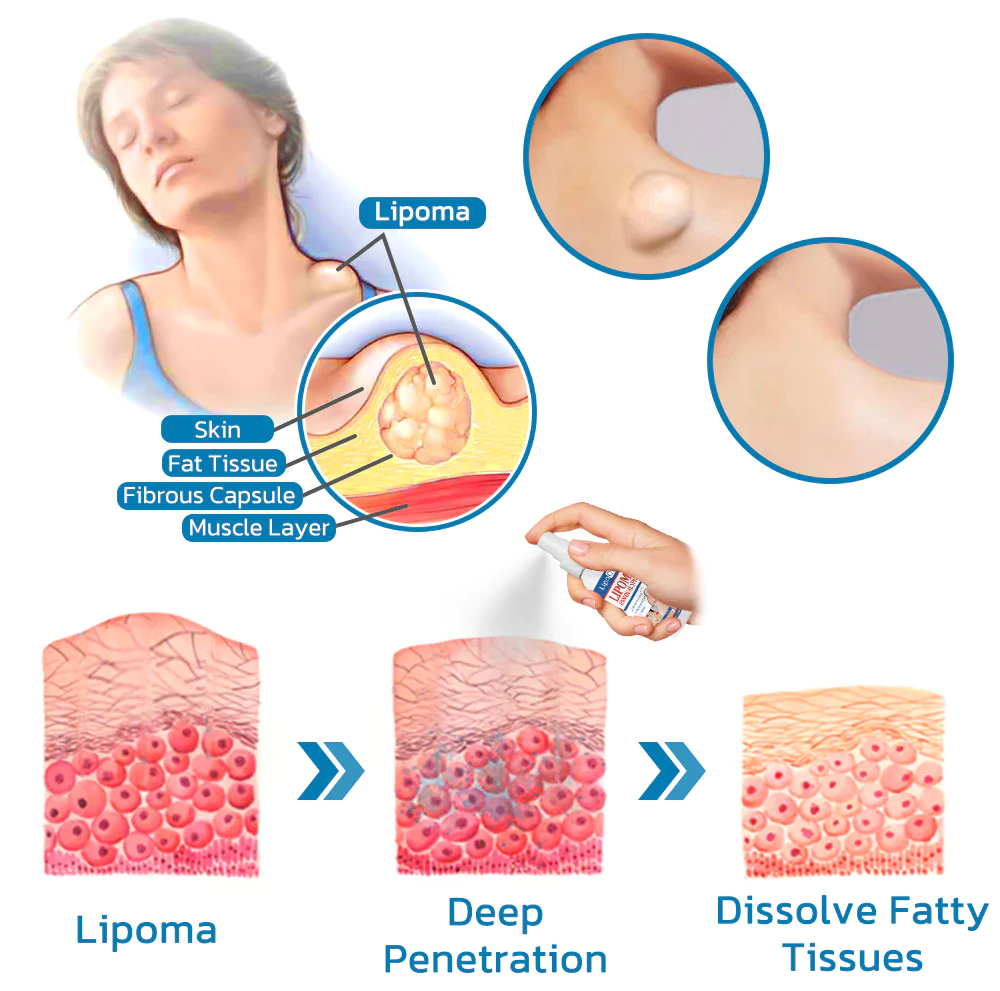 LipoOut Lipomheilung Lessening Spray - Image 6