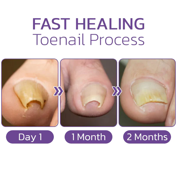 Japanese Elastic Toenail Correction Patch - Image 4