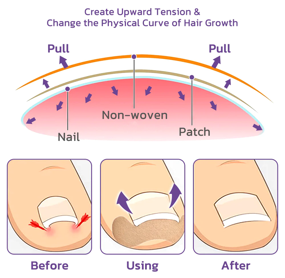 Japanese Elastic Toenail Correction Patch - Image 6