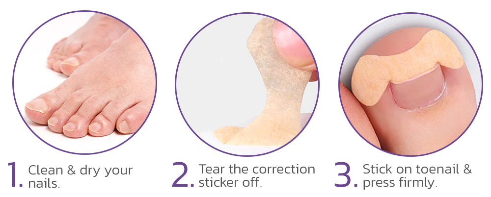 Japanese Elastic Toenail Correction Patch - Image 7