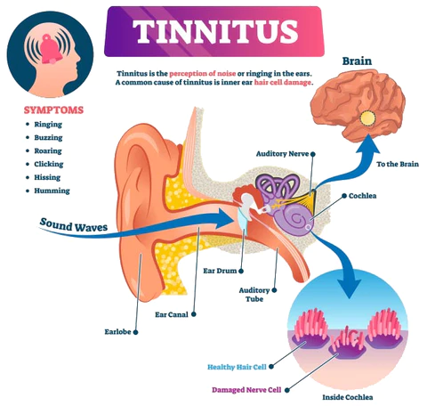 TinnitusRelief™ Ear Care Patch - Image 6
