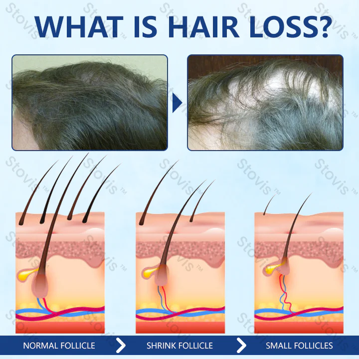 STOVIS™ RevitaRoot Hair Regrowth Cream - Image 2
