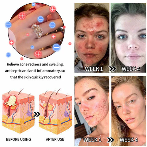 Диамантен пръстен с лимфна магнитна терапия DIYSTAR™ - Изображение 3