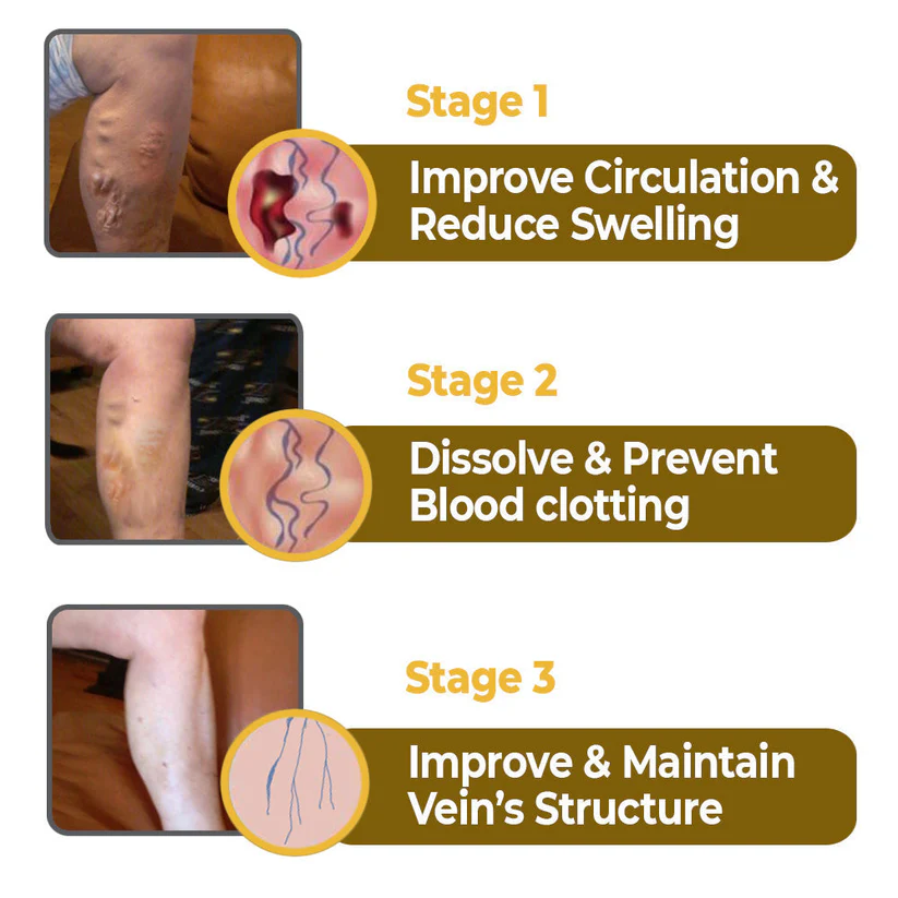 flysmus™ VaricoX Vein Dredge Bee Venom Spray - Image 3