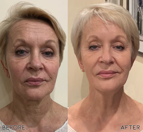 Oveallgo™ NewBornSkin MicroInfusion Needling System - Image 3