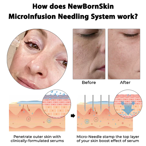 Oveallgo™ NewBornSkin MicroInfusion Needling System - Image 5
