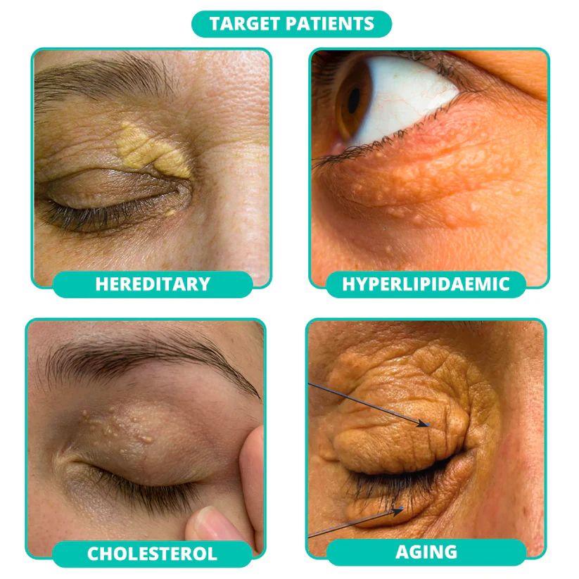 Ourlyard™ OphthlaXcare Xanthoma Treatment Vision Enhance Eye Ointment - Image 3